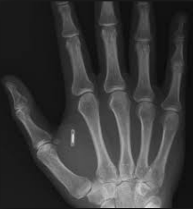 Are You For Or Against The RFID Chip Implant